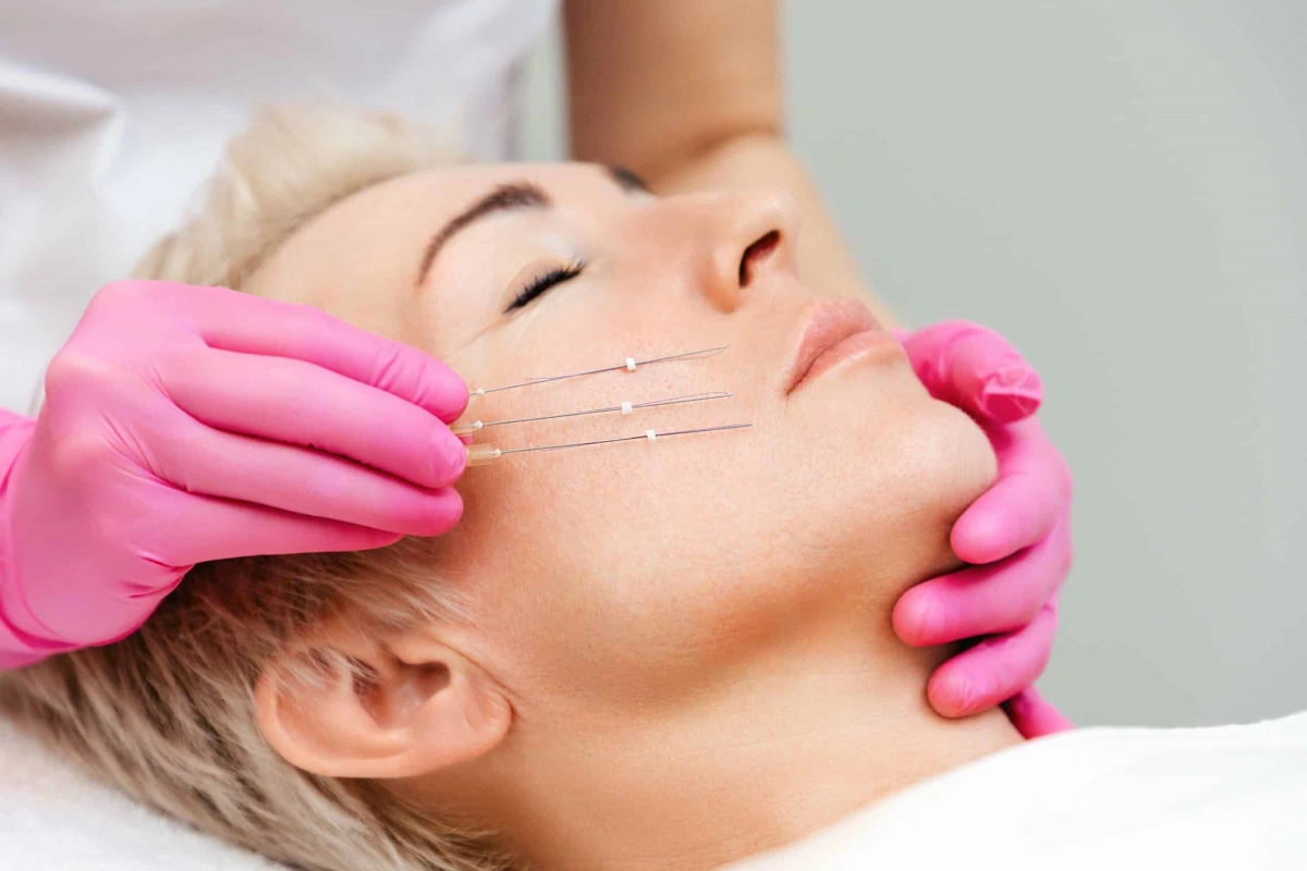 thread-lift-cosmetic-procedure-8