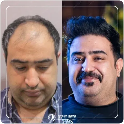 بهترین کلینیک های کاشت مو در ایران بهترین کلینیک های کاشت مو در ایران