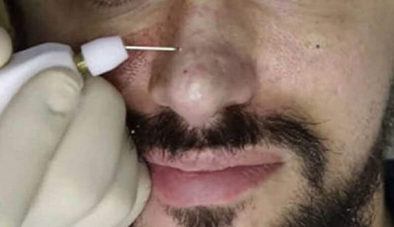 عکس/ جراحی معجزه آسای بینی یک مرد ۵۷ ساله!