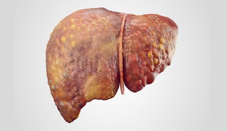 این خوراکی‌ها کبد چرب را درمان می‌کنند!