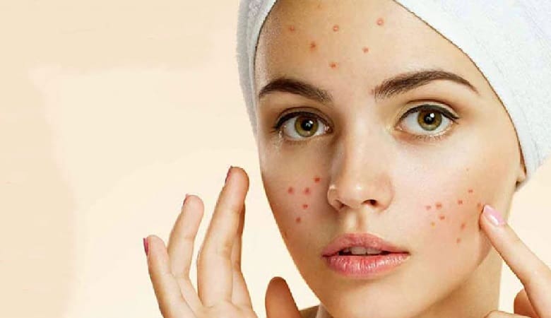 جوش صورت در قسمت‌های مختلف آن علامت چه چیزی است؟