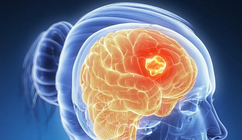 با این علائم احتمال تومور مغزی را جدی بگیرید!