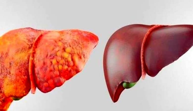 مهمترین علایم کبد چرب را بشناسید!