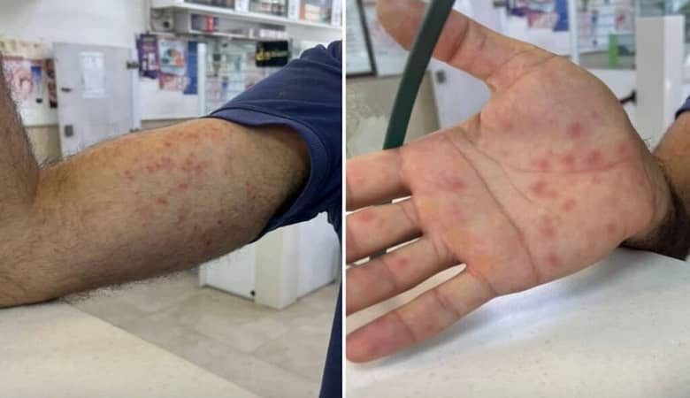 علائمی که اطلاع می دهد مبتلا به “آبله میمون” شدید