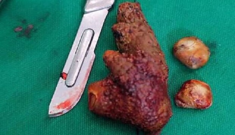 کشف عجیب از کلیه یک بیمار در گناوه