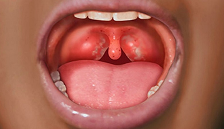 درمان سکسکه و گلو درد با این خوراکی سبز رنگ