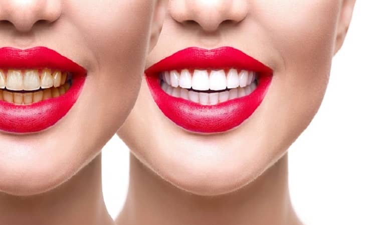 نسخه شگفت انگیز خانگی برای رفع جرم دندان در 5 دقیقه!