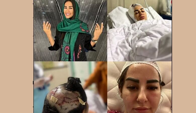 گفتگو با آرایشگر زن که طعمه سگ لاکچری شد!